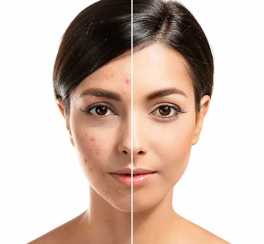 خدمات درمانی جوش بدن 830